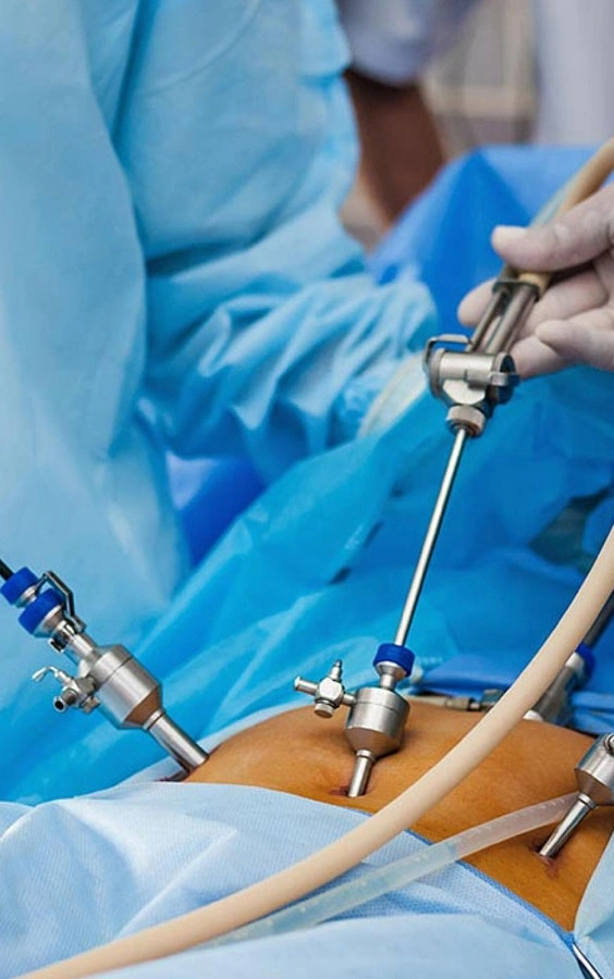 Cirugía laparoscópica de vesícula